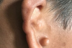 Atresia, microtia, accesory auricle, R ear, (Lear normal), 15y Boy.