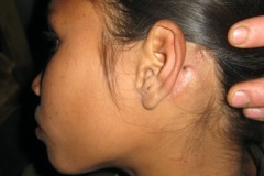 Congenital pinna, canal stenosis, postaural fistula, cholesteatoma.