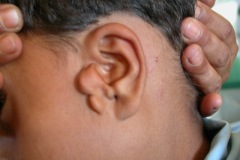 Congenital pinna, duplication and canal atresia.