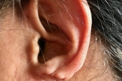 Lobe of pinna absent, congenital (with past ineffective reconstructive surgery scars), female adult.
