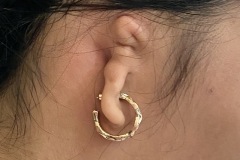 Microtia and canal atresia, unilateral, 18y female, subsequently underwent reconstruction with rib cartialge.