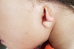 Microtia left ear, young girl.