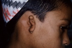 Microtia of auricle, atresia of ear canal.
