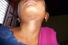 Thyroglossal sinus.