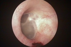 Tympanic membrane, slightly abnormal malleus handle, C HL, ? congenital ossicular abnormality, L ear.