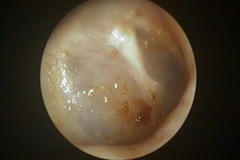 Tympanic membrane, slightly abnormal malleus handle, C HL, ? congenital ossicular abnormality, R ear.