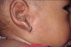 CSOM, infant, R ear, chronic discharge and secondary skin infection.