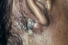 Postaural fistula, from CSOM (ointment in concha).