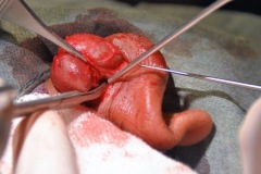 Postaural serous cyst, teenage boy, per-op