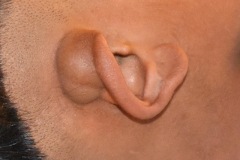 Postaural serous cyst, teenage boy, pre-op
