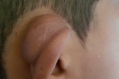 Dermoid cyst, retroauricular, recurrent, young boy, R ear.