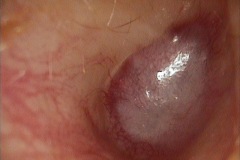 Acquired atresia, R ear, post-inflammatory myringitis, with CHL.