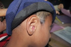 Aural granuloma, arising in anterior canal wall, drum normal