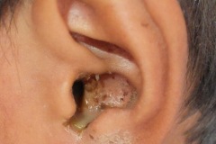 Bilateral discharge, TT CSOM, Left ear, boy