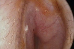 Bony stenosis L ear canal.