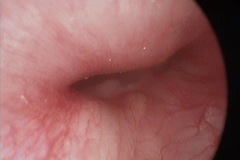 Bony stenosis of L EAC, large sessile osteomata.