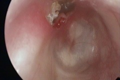 Cholesteatoma eroding through form attic into canal.