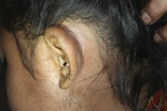 Chronic ear discharge