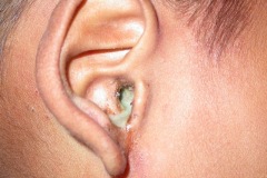 Chronic mucopurulent ear discharge, CSOM
