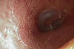 Ear canal, 'waves' of migrating epithelium visible, TM normal, right ear.