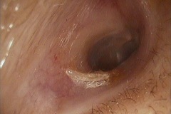 Ear canal, cotton fibres, excessive cleaning, normal typmanic membrane, right ear.