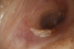 Ear canal, cotton fibres, minor trauma, excessive cleaning, right ear.