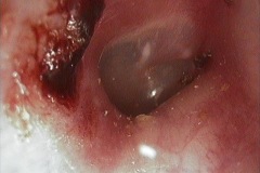 Ear canal, minor trauma by self cleaning, blood clot on posterior wall, TM intact.