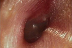 Ear canal, normal variant right ear, normal TM.