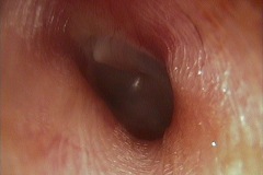 Ear canal, normal variant, left ear, normal TM.