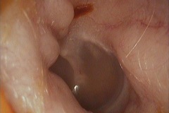 Exostoses in left ear canal, male 40y,a.