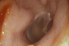 Exostoses in right ear canal, male, 40y,a.