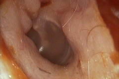 Exostoses left ear canal, male 40y,b.