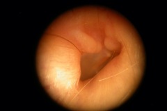 Exostoses, and osteoma