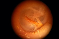Foreign body, seed