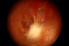 Fungus and perforation