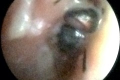 Insect and pus in child's ear