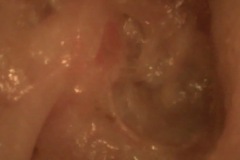 Keratosis Obturans expanded canal, 50y F, R ear, exposed vertical VII and incus, normal hearing, intermittent discharge.