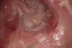 Keratosis obturans sequelae, canal floor and attic erosions, expanded canal, wet pockets, rec granulations, CHL.