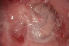 Keratosis obturans sequelae, f 38y, recurrent ear discharge.