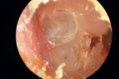Keratosis obturans, expanded ear canal.