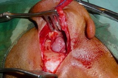 Large polyp, R ear
