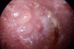Myringitis Bullosa, right ear.