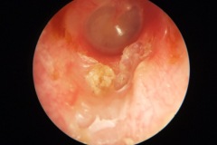 Osteitis/Cholesteatoma of ear canal floor.