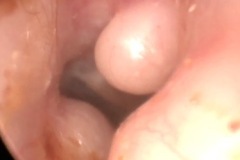 Osteoma near drum and exostoses at front and back of bony ear canal, L ear.