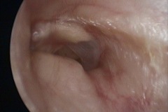 Osteoma of EAC, tympanosclerosis patch and dry perforation in TM, R ear.