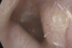 Osteomas L ear,B