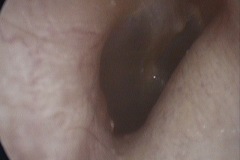 Osteomas R ear,A