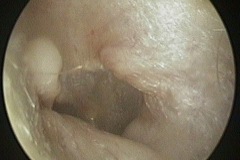 Osteomas and exostoses L ear,Pt G