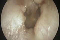 Osteomas and exostoses R ear,Pt G.