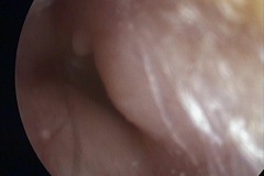 Osteomas and exostosis, L ear.